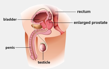 Medical illustration that shows the men's prostate, penis, testicle, bladder and rectum.