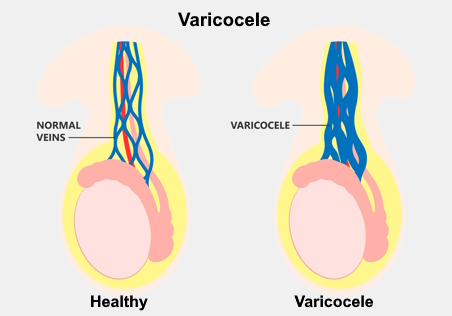 Anatomic illustration showing a healthy testicle and one with enlarged veins (varicocele).