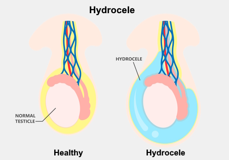 Anatomic illustration Illustration of a healthy testicle and one with fluid in the scrotum (hydrocele).