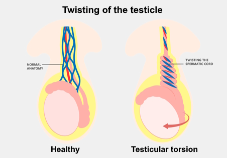 Anatomic illustration showing a healthy testicle and one with a twisted spermatic cord (testicular torsion).