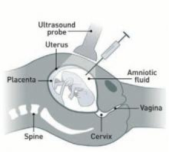 Medical illustration that shows how an amniocentesis is done