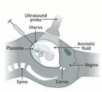 Medical illustration that shows how a CVS is done.